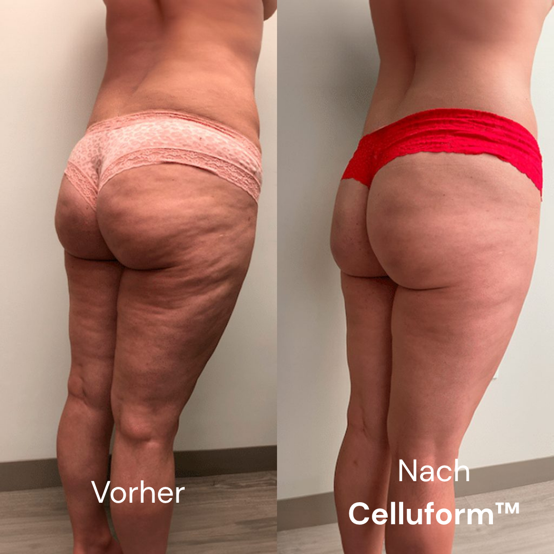 Celluform™